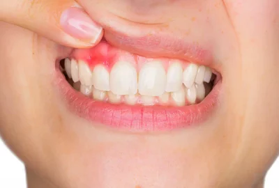 Fix-Heal-Treat-Abscessed-Tooth-VCDP